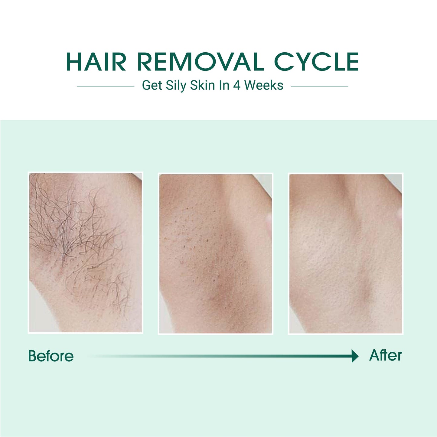 Laser IPL Hair Removal-3