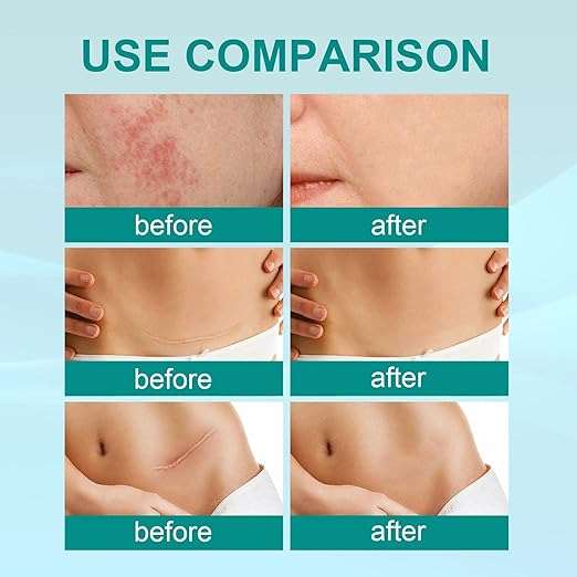 South Moon  Scar Spray